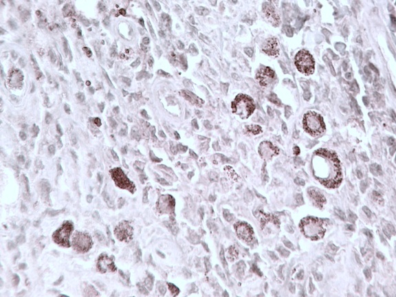 Immunohistochemical staining of human melanoma tumor tissue using chx10 (CT) antibody (Cat. No. X1179P).  Antibody used at ~20 µg/ml.